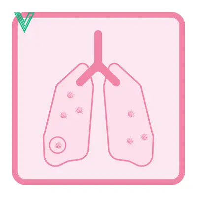 Illustration of Lungs with Cancerous Nodules
