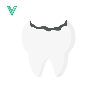 Illustration of a Cavity in a Tooth