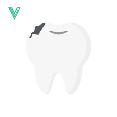 Illustration of a Damaged Tooth with Cavity