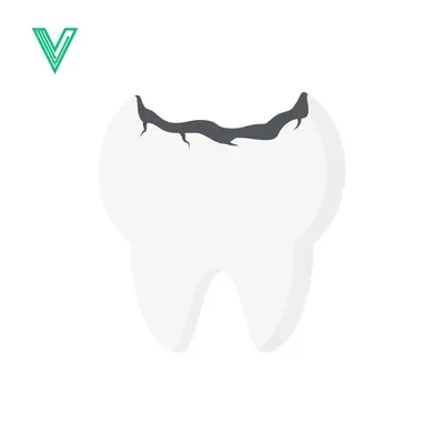 Illustration of a cracked tooth with dark decay on the biting surface
