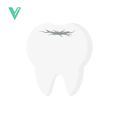 Illustration of a Cracked Tooth with Decay