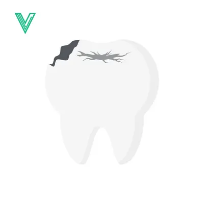 Illustration of a Cavity in a Tooth
