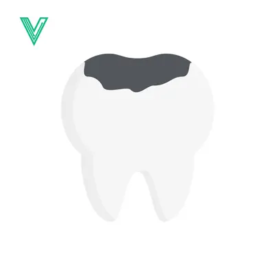 Illustration of a Tooth with a Cavity
