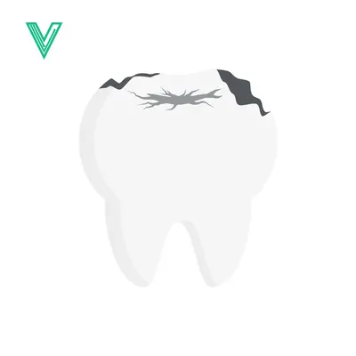 Illustration of a Damaged Tooth with Cavities and Decay