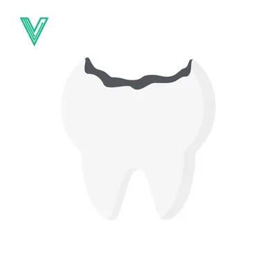 Illustration of a Cavity in a Tooth