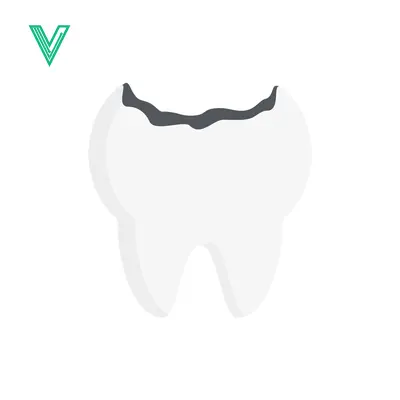 Illustration of a Cavity in a Tooth