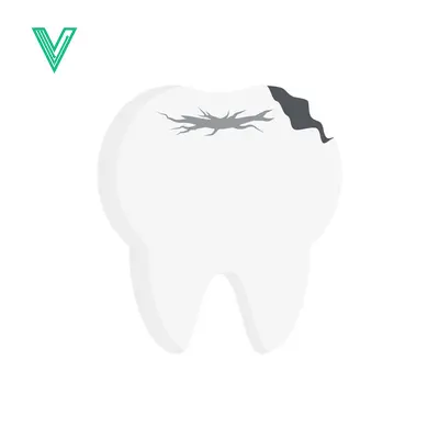 Illustration of a damaged tooth with decay and cracks