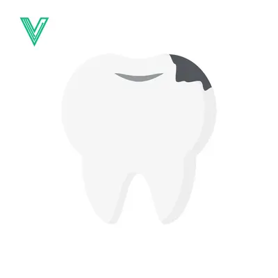 Illustration of a Cavity in a Tooth