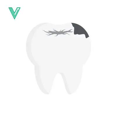 Illustration of a damaged tooth with a cavity and decay