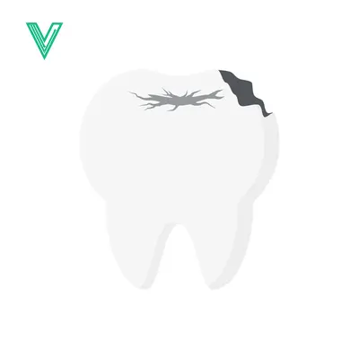 Illustration of a Damaged Tooth with Decay and Cracks