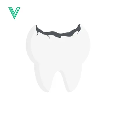 Illustration of a Cavity in a Tooth