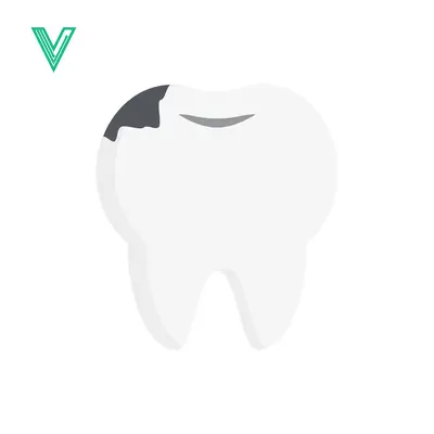 Illustration of a Cavity in a Tooth