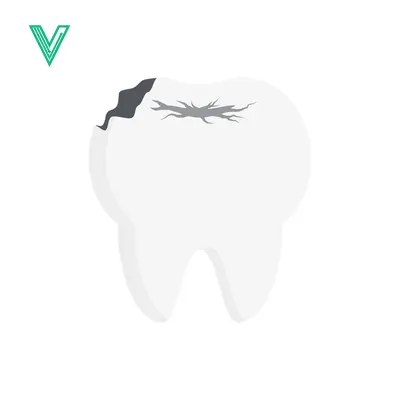 Illustration of a damaged tooth with a cavity and decay