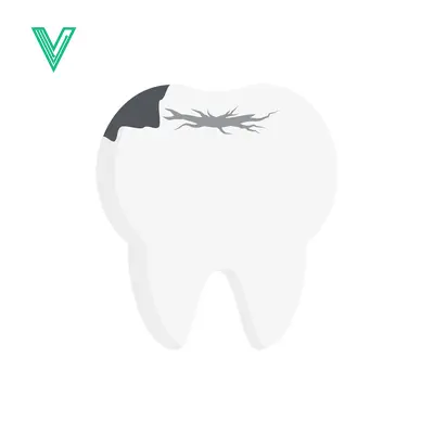 Illustration of a Cavity on a Tooth